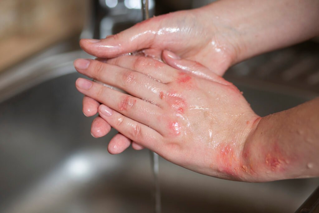 hands patient suffering from psoriasis